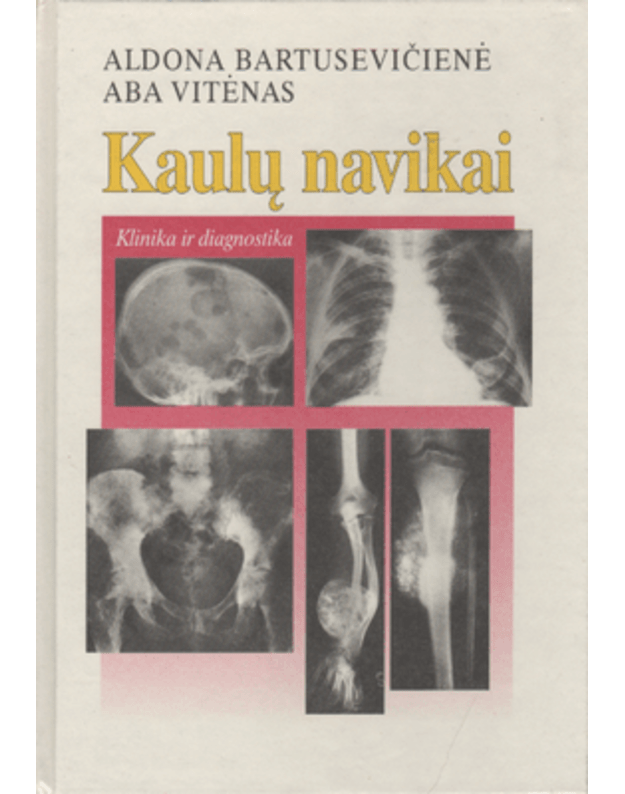 Kaulų navikai. Klinika ir diagnostika - Bartusevičienė Aldona, Vitėnas Aba